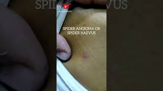 Spider Angioma or Spider Naevus  Chronic Liver Disease [upl. by Ikilisav]