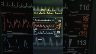 Intra Aortic Balloon Pump IABP cardiology [upl. by Ayital]