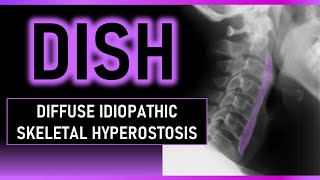 Diffuse Idiopathic Skeletal Hyperostosis dish radiology bones [upl. by Nallij]