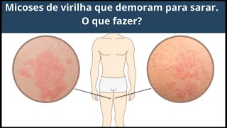 Micoses de virilha que demoram para sarar O que fazer [upl. by Ayikal]