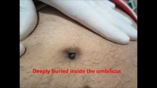 Clean Your Navel Belly Umbilicus Properly Or You may Face this In Your Belly Button [upl. by Marla]