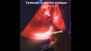 Cystocele demo on tvs in patient of uterine prolapse [upl. by Tinya]