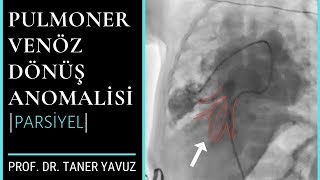 Pulmoner Venöz Dönüş Anomalisi PAPVR [upl. by Thor]