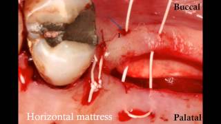 How to suture a large flap a SurgicalMaster Instant Replay [upl. by Loydie281]