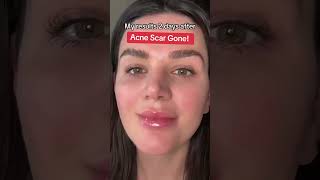 How To Fade Acne Scars Quickly With This Skincare Kit acne acnescars microneedling [upl. by Chaworth]