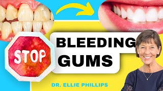 How To QUICKLY Treat Gingivitis and Bleeding Gums [upl. by Nahsad659]