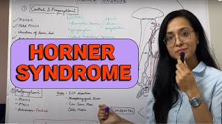 HORNER syndrome [upl. by Bruis]