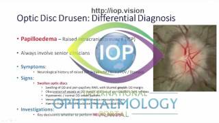 Optic Disc Drusen Part 2 Preview [upl. by Noevad]