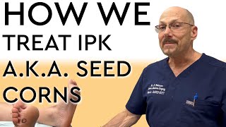 How We Treat IPK  Porokeratosis  Seed Corns [upl. by Sufur]