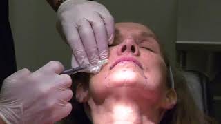 Injection of Botulinum Toxin for Treatment of Perioral Rhytids by Dr Z Paul Lorenc [upl. by Irita]