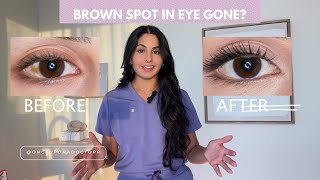 Brown Spot in Eye Gone [upl. by Phelan472]