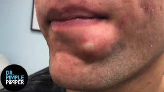 SATISFYING Dr Lee Pops Inflamed Cyst on Chin  Dr Pimple Popper Reacts [upl. by Toole757]