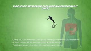 Endoscopic Retrograde Cholangiopancreatography ERCP [upl. by Lozano]