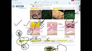 EPIDERMOLYSIS BULLOSA SIMPLEX [upl. by Atsillak]