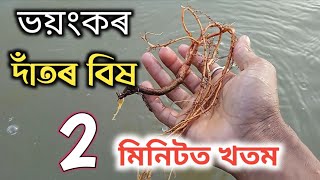 ভয়ংকৰ দাঁতৰ বিষ দূৰ কৰা উপায়💯।Dat Bikh Hole Ki Karibo Lage।Dat Bikhor Upay Assamese 👍👍Part7 [upl. by Inihor]