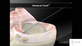 Dr Bruno Lévy  Suture méniscale sous arthroscopie [upl. by Nitsed]