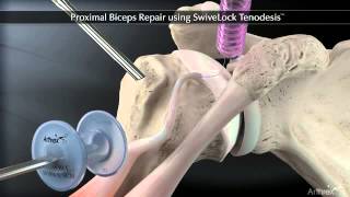 Proximal Biceps Repair using Arthrex SwiveLock® Tenodesis [upl. by Akisey]