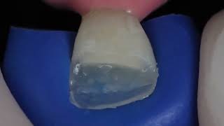 Composite bonding and tooth reconstruction using IPS Empress Direct from Ivoclar [upl. by Akimrehs]