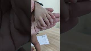 Polydactyly orthopedicshortcase pediatricorthopedics [upl. by Uhayile]