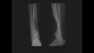 Surgical Treatment of Chronic Osteomyelitis in the Tibia Silent Petrolagar Laboratories 1924 [upl. by Fellner]