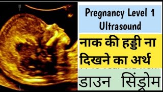 Absent Nasal Bone in pregnancy nt scan डाउन सिंड्रोम कोख में जाने बच्चा स्वस्थ है [upl. by Lednyc]