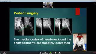 Anteromedial Reduction amp Stabilization of Unstable Trochanteric Fracture Dr Wasudeo Gadegone [upl. by Nerad]