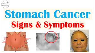 Stomach Cancer Signs and Symptoms  Clinical Manifestations of Gastric Cancer [upl. by Kissiah398]