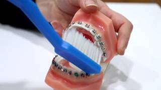 Cómo cepillarse los dientes con Brackets  Prodental Clinica dental [upl. by Karlyn406]