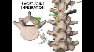 ULTRASOUND GUIDED FACET JOINT AND MEDIAL BRANCH INFILTRATION [upl. by Siro464]