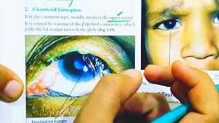 Entropion  Treatment of Entropion  Causes of entropion  Entropion and Ectropion Eye lectures [upl. by Agnot143]