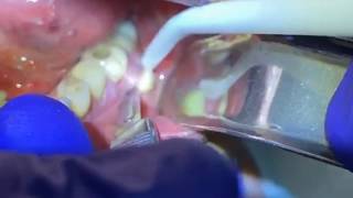 Draining a Dental Abscess  Advanced Dental Care [upl. by Trevlac]