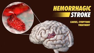 Hemorrhagic Stroke  What is it Causes Symptoms and Treatment  3D Guide [upl. by Ueih]