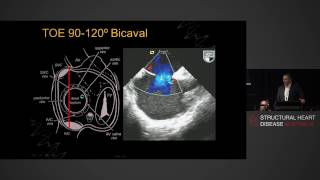 Atrial Septum  Anatomy Echocardiography amp Interventions  AProf Gregory Scalia [upl. by Acissehc150]