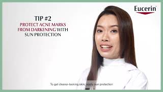 Tips to Effectively Reduce amp Prevent Acne Marks [upl. by Dickenson686]