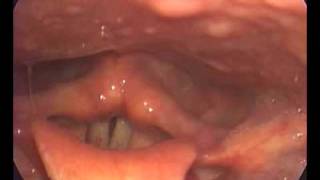 petechiae  thick phlegm  tiny polyp  high risk of hemorrhagemp4 [upl. by Gunthar354]