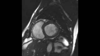 Cardiac MRI  Short axis view with tricuspid amp mitral valve [upl. by Lede]