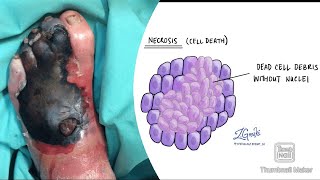 Necrosis and its types coagulative liquefactive caseous fat fibrinoid necrosis fmge neetpg [upl. by Attolrahc357]