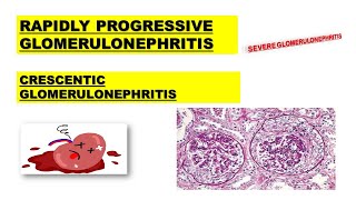 RPGN  Rapidly Progressive Glomerulonephritis  Poor Prognosis  Made Easy [upl. by Nezah547]