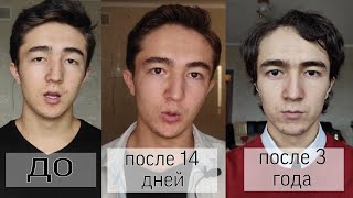 Нитевая блефаропластика После 3 года Моя история операции VLOG style [upl. by Eiggam]