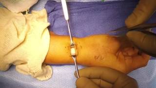 First Extensor Compartment Release for deQuervains Tenosynovitis [upl. by Themis323]