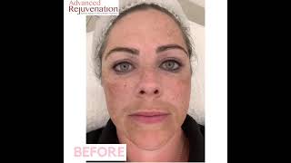 Cosmelan Treatment Results  Skin DePigmentation and Anti Ageing  By Advanced Rejuvenation [upl. by Geffner562]