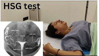 My HSG  tube test  experience😓 without anesthesia bht painfull hota h [upl. by Rains311]