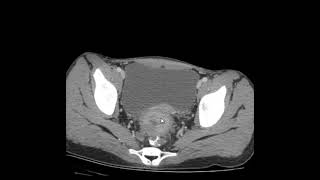 Adenocarcinoma mucinoso do reto [upl. by Cchaddie936]