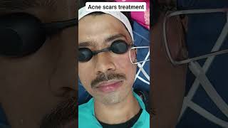 Acne scars treatment I laser for acne scars I TCA for scars  fractional CO2 laser [upl. by Krock]