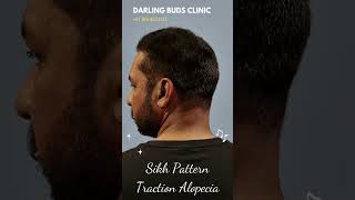 Hair transplant in India for Sikh pattern traction alopecia  before and after result [upl. by Garlaand]