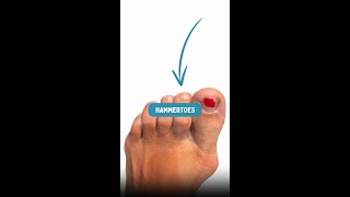 What is a hammertoe hammertoe podiatrist [upl. by Becky]