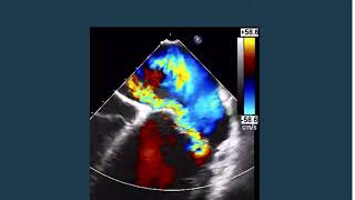 Severe Prosthetic MV Paravalvular Leak TEE3D [upl. by Eshelman]