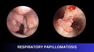 RESPIRATORY PAPILLOMATOSIS  Bronchoscopic Management [upl. by Ojadnama]