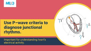 How to diagnose junctional rhythms [upl. by Calan558]