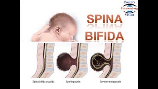 Spina Bifida les Causes et la Prévention par acide folique vitamine B9 [upl. by Nireil]